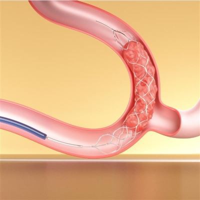 Stent Retriever Česanje z aspiracijskim katetrom